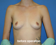 plastic-surgery-breast-augmentation